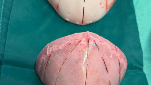 Bimbo di 9 mesi operato con successo per malformazione al cranio